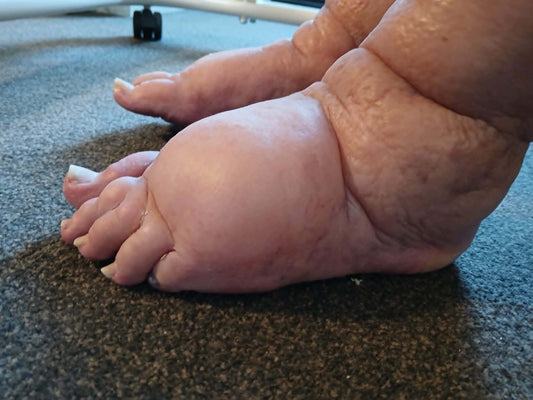 How we helped find the perfect slippers for badly swollen feet - a real NZ story